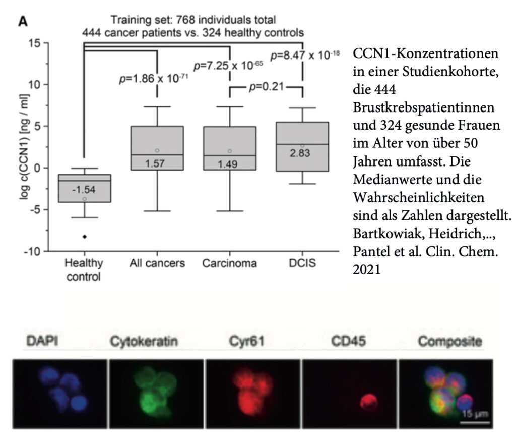 Nachweis von Cyr61 in CTC aus dem peripheren Blut von Brustkrebspatientinnen Nachweis von Cyr61 in CTC aus dem peripheren Blut von Brustkrebspatientinnen